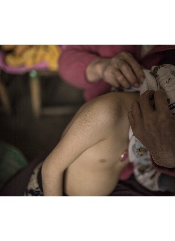 罕见病9岁变毛孩 广州美莱帮助脱毛