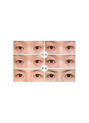 杭州艺星割双眼皮要花多少钱?