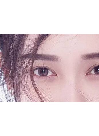 杨亚益：双眼皮手术失败后如何修复？