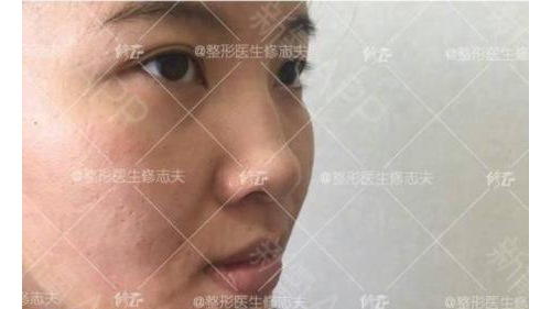 品牌机构双眼皮美容修志夫莎吉特双眼皮效果如何