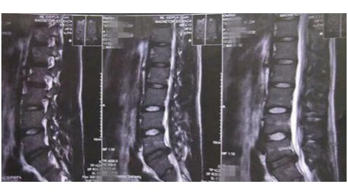 感谢冯记四位定穴法，来自一位3年腰病全职妈妈的分享